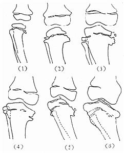 遠端腎小管性酸中毒