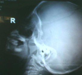 腺樣體增生 腺樣體增生