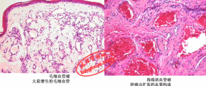 脈管瘤 脈管瘤
