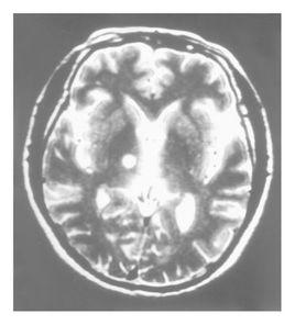 帕金森病的定向手術 帕金森病的定向手術