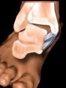 踝關節扭傷 踝關節扭傷