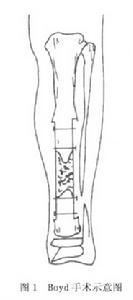 先天性脛骨假關節