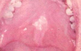 口腔白色角化病 口腔白色角化病