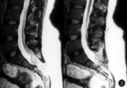脂肪栓塞綜合徵