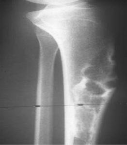 骨纖維結構不良 骨纖維結構不良