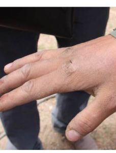 季節性手脫皮 季節性手脫皮