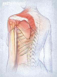 先天性高肩胛症