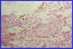 特發性肺含鐵血黃素沉著症