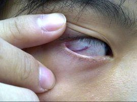 眼睛充血 眼睛充血