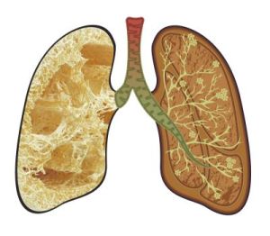 肺纖維化 肺纖維化