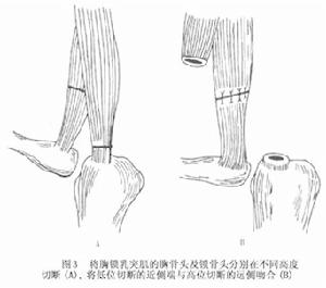 先天性斜頸 先天性斜頸