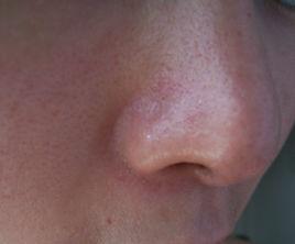 裸臉治療激素依賴性皮炎 裸臉治療激素依賴性皮炎