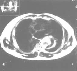 胸主動脈夾層動脈瘤