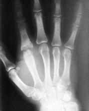 小兒急性化膿性關節炎 小兒急性化膿性關節炎