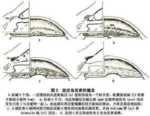 原發性嬰幼兒型青光眼