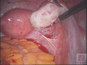 大網膜粘連綜合徵 大網膜粘連綜合徵