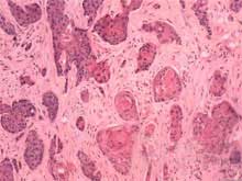 角膜鱗狀細胞癌