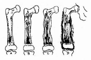 急性血源性骨髓炎