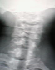 肌張力障礙綜合徵 斜頸