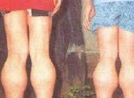 肢體過度肥大 肢體過度肥大