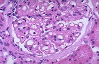 隱匿性腎小球腎炎