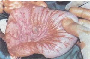 先天性巨結腸症