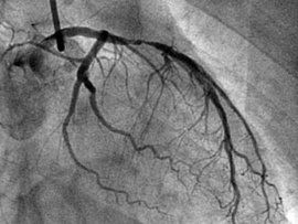 心臟照影 心臟照影