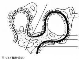 微小病變型腎病