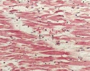 非ST段抬高心肌梗死 非ST段抬高心肌梗死