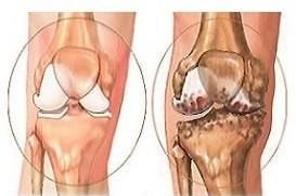 跟骨骨膜炎 跟骨骨膜炎