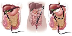 擬消化腔 擬消化腔