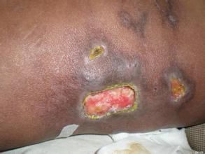 回歸熱型結節性非化膿性脂膜炎 回歸熱型結節性非化膿性脂膜炎