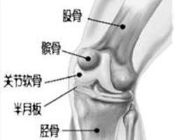 膝關節炎 膝關節炎