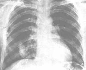 胸膜鈣化 胸膜鈣化