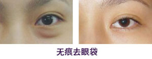 韻致祛眼袋 韻致祛眼袋
