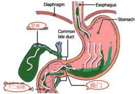 膽汁反流 膽汁反流