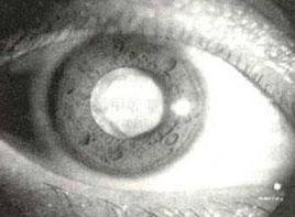 晶狀體鐵質沉著 晶狀體鐵質沉著