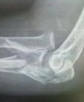 尺骨鷹嘴骨折 尺骨鷹嘴骨折