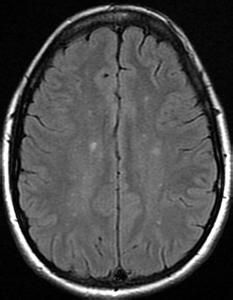 主動脈弓綜合徵視網膜病變 主動脈弓綜合徵視網膜病變