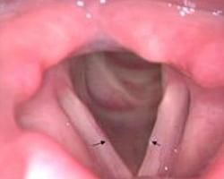 兒童聲帶小結 兒童聲帶小結