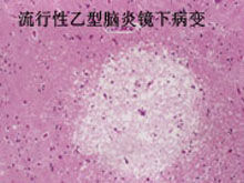 流行性乙型腦炎