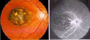 迴旋狀脈絡膜視網膜萎縮