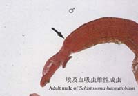 （圖）膀胱鱗狀細胞癌