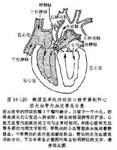 單純肺動脈口狹窄