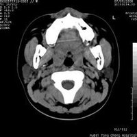 顳窩纖維血管瘤