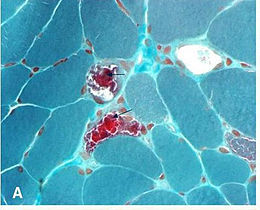 肌抽躍癲癇合併紅色襤褸肌纖維症