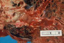 肺鱗癌組織照片