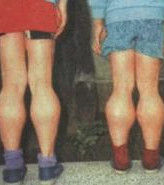 假肥大性肌營養不良 假肥大性肌營養不良