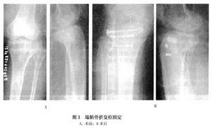 （圖）脛骨平台骨折