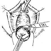 尿道旁腺 尿道旁腺